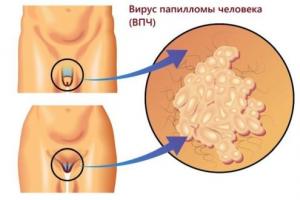 Вирус папилломы человека у женщин: причины, признаки и лечение