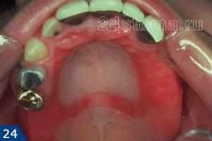 Stomatitis treatment in adults: how to treat