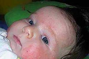 Symptoms and treatment regimen for allergic dermatitis in children under one year of age and older
