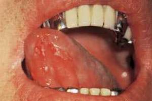 Kaip gydyti stomatitą suaugusiems burnoje: simptomai, gydymas, nuotraukos